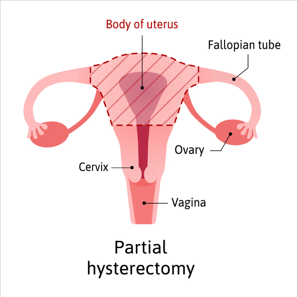 자궁은 크게 자궁체부(body of uterus, 빗금친 부분 안쪽), 자궁과 질을 연결하는 목부분인 자궁경부(cervix)로 나뉜다. 최근 자궁경부암 환자는 줄고 자궁체부암 환자가 느는 추세다./게티이미지뱅크