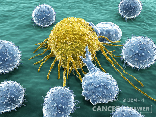 전이암 개수가 적은 소수전이암일 때 없애는 치료를 하면 암 진행을 막는 데 효과적이다./게티이미지뱅크