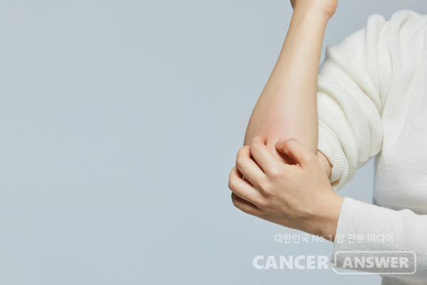 건선은 적절한 치료를 받고 피부가 건조하지 않게 하는 것이 중요하다./게티이미지뱅크