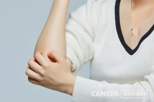 모기가 기승을 부릴 때는 봉와직염을 조심해야 한다./게티이미지뱅크