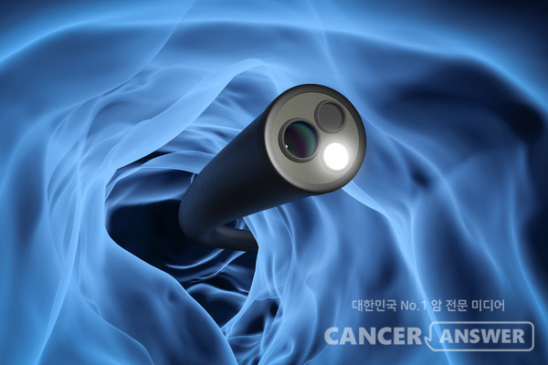 국가 대장암 검진 사업에서 1차 검사 때부터 분변검사 대신 내시경검사를 하는 방안이 추진되고 있다. / 게티이미지뱅크