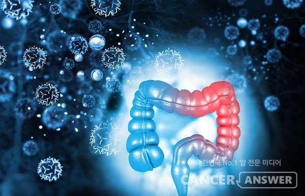 알부민-근지방 지수(AMG)를 분석하면 대장암 환자의 치료 후 상태를 예측할 수 있다는 연구결과가 나왔다. / 게티이미지뱅크