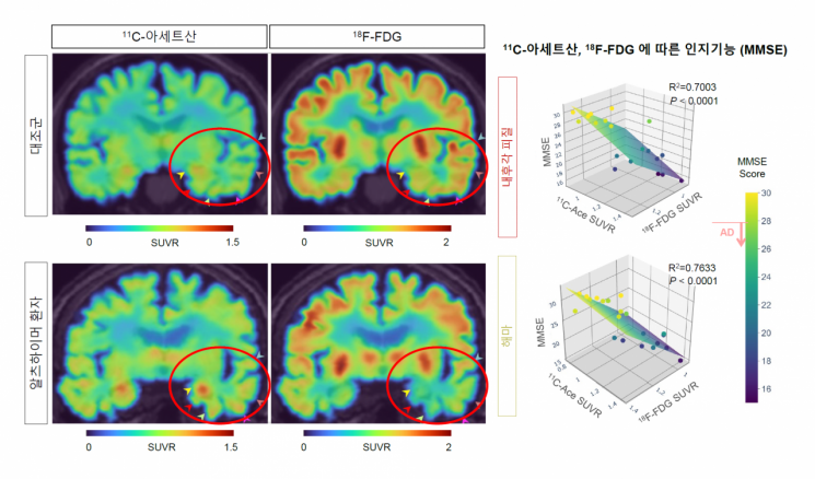 알츠하이머 환자의 PET 영상 및 11C-아세트산 및 18F-FDG 흡수 변화에 따른 인지기능의 상관관계. / 기초과학연구원