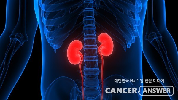 신장암은 재발 전이가 잘되고 치료가 어려운데, 최근 면역항암제인 옵디보와 여보이를 함께 쓰는 병용요법이 치료 효과는 높고 부작용이 적은 치료법으로 인정받고 있다./게티이미지뱅크