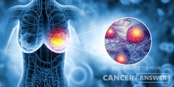 조직검사가 어려운 유방암 환자의 재발, 전이 여부를 진단하는 '18F-FES PET 검사'가 미국종합암네트워크의 가이드라인으로 선정됐다./게티이미지뱅크