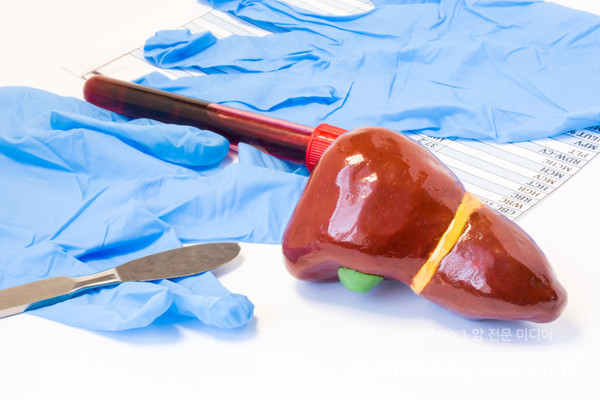 중증 말기 간질환 환자도 생체 간이식을 받으면 생존율이 높아진다는 국내 연구 결과가 나왔다../게티이미지뱅크 