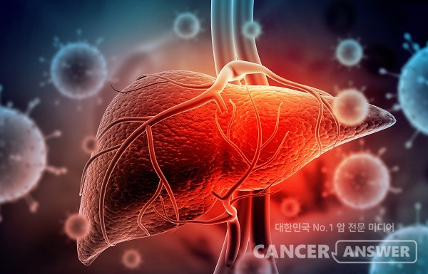 비알코올 지방간이 있으면 치매 발병 위험이 1.5배 높은 것으로 국내 연구에서 나타났다. / 게티이미지뱅크