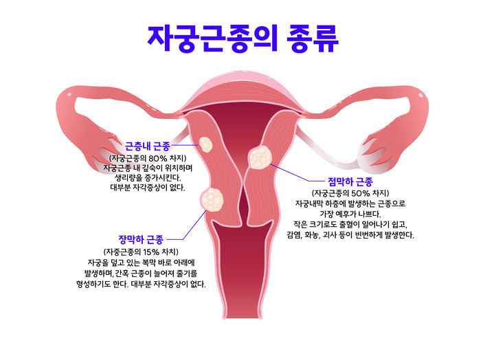 자궁근종은 종양이긴 하지만 대부분 양성이다. 하지만 드물게 암으로 바뀌는 경우도 있기 때문에 정기 검진을 통한 진단과 치료가 필요하다./게티이미지뱅크