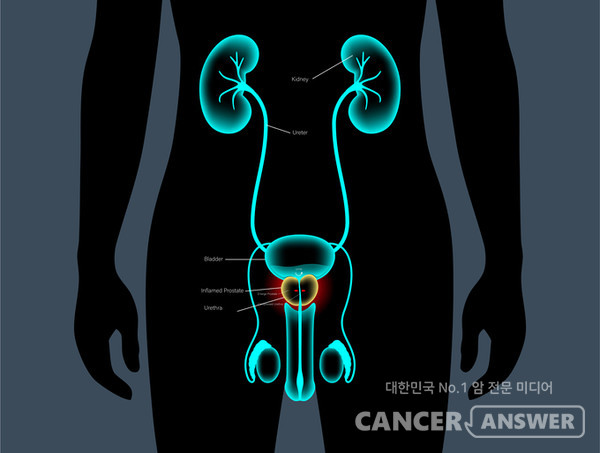 몸에 쌓인 납의 농도가 2배 높아질 때마다 전립선암 발병률도 2배 높아진다는 연구 결과가 나왔다./게티이미지뱅크