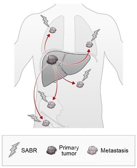 암 전이 초기 단계인 '소수 전이성 간암'에 시행하는 체부 정위적 방사선치료(종양에 집중적으로 고선량을 조사하는 방사선 치료)의 원리/ 연세암병원 제공