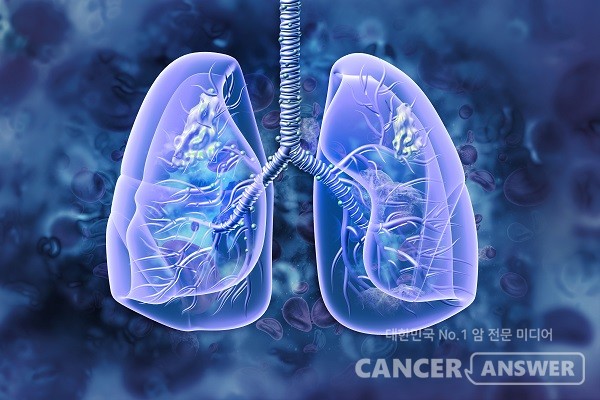 폐암 치료 효과가 타그리소의 2.6배인 4세대 폐암 표적치료제 'BI-4732'에 대한 전임상 연구 결과가 발표됐다. / 게티이미지뱅크
