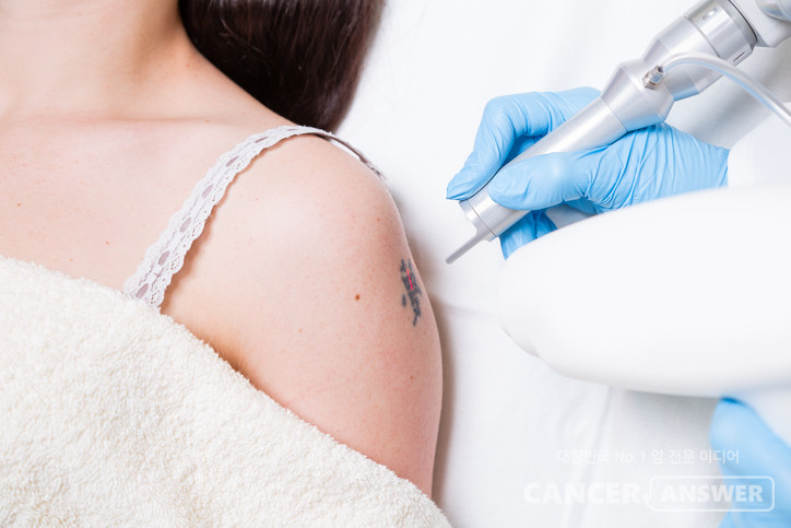 문신이 혈액암의 일종인 림프종 위험을 높인다는 해외 연구 결과가 나왔다./게티이미지뱅크