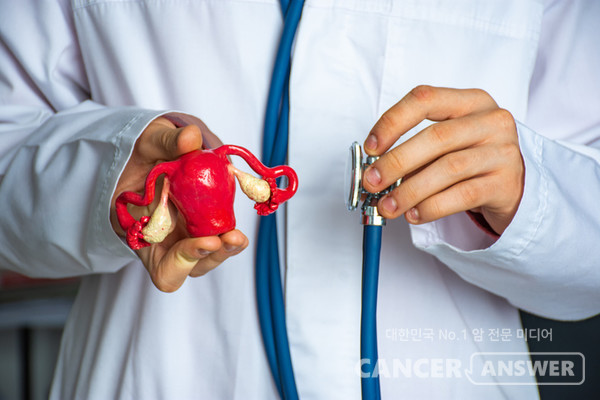 대장암 치료를 받았거나 대장암 진단을 받은 직계가족이 있는 여성은 자궁암, 난소암 등 부인암 발병 위험이 높다고 한다./게티이미지뱅크