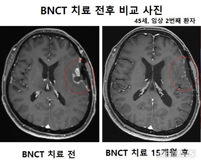 붕소중성자포획치료기(A-BNCT) 치료 전후 사진. A-BNCT는 붕소 화합물을 체내 주입한 후 붕소를 섭취한 종양 세포에 중성자를 조사해 핵반응을 일으켜 종양 세포만 사멸시키는 치료법이다./가천대 길병원 제공