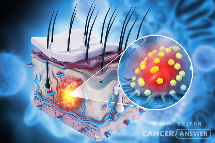한국인에게 드문 암으로 알려진 피부암이 최근 20년 사이 7배로 급증한 것으로 나타났다. 사진은 피부암 개념도./게티이미지뱅크