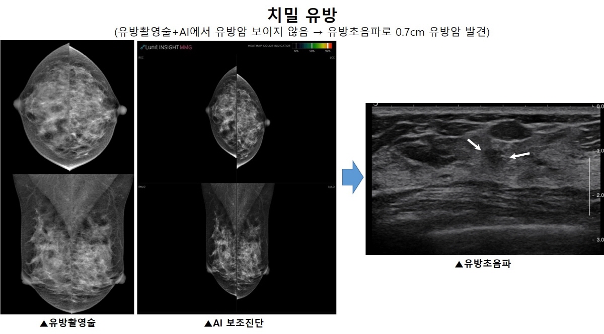 ​치밀유방에서 유방촬영술과 AI로 보이지 않던 유방암이 유방 초음파 상에서는 발견​된다(흰색 화살표)./서울대병원 제공