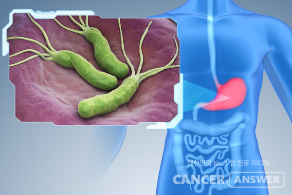 헬리코박터(파일로리)균 감염으로 인한 위궤양이 치매 위험을 3배로 높인다는 연구 결과가 나왔다. 가톨릭의대 정신건강의학과 서울성모병원 강동우 교수(제1저자), 여의도성모병원 뇌건강센터 임현국 교수(교신저자) 연구팀은 국민건강보험공단 데이터베이스를 활용해 연구한 결과다. 이 연구 결과는 미국노화학회 공식 학술지인 '제로사이언스(Geroscience)' 최근호에 게재됐다./ 티이미지뱅크