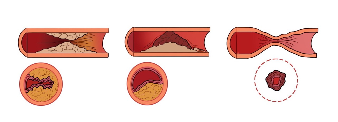 뇌졸중의 주요 원인으로 꼽히는 동맥경화가 진행된 혈관의 단면./서울아산병원 제공