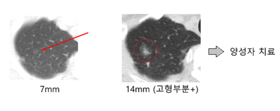사진 왼쪽은 지난 2002년 저선량 흉부 CT검사에서 발견한 7mm 크기의 결절. 왼쪽 결절이 133개월 만에 14mm로 커진 오른쪽 결절을 삼성서울병원 연구팀이 양성자로 치료했다./삼성서울병원 제공