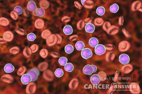 백혈병 등 혈액암 치료 중 조혈모세포를 이식할 때 나타나는 합병증과 이식거부반응 등의 위험을 크게 줄인 치료법이 발표됐다. 가톨릭대 성빈센트병원 혈액내과 김정아 교수 연구팀은 이식 후 시클로포스파미드(PT-CY) 기반 조직적합항원(HLA) 반일치 조혈모세포이식 치료에서 항암제인 플루다라빈을 저용량으로 3일간 투여하는 방법으로 생존율은 높이고 재발률은 낮추는 효과가 확인됐다고 26일 밝혔다./게티이미지뱅크