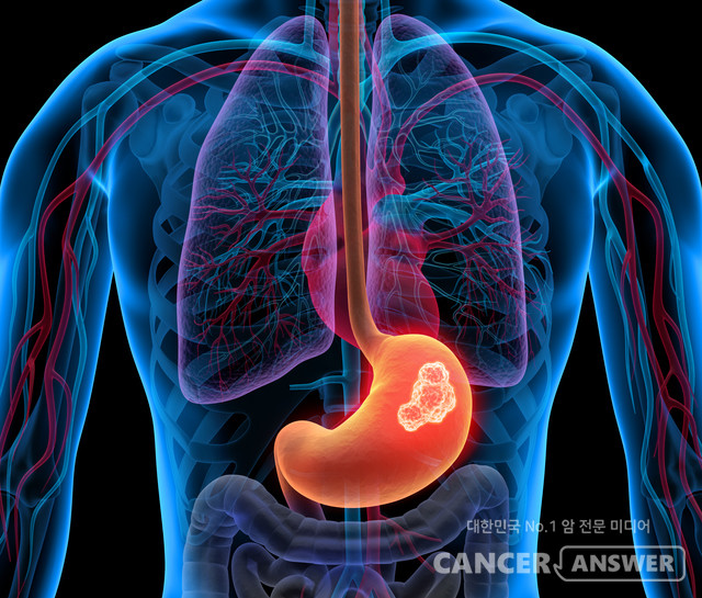 위암이 유전될 수 있다는 국내 연구 결과가 나왔다. 린치증후군이라는 유전적 요인이 위암 발생에 영향을 미칠 수 있다는 사실을 순천향대학교 부천병원·천안병원 외과 공동 연구팀(최윤영, 윤종혁, 송금종, 이문수 교수)이 아시아 최초로 밝혀낸 것이다./게티이미지뱅크