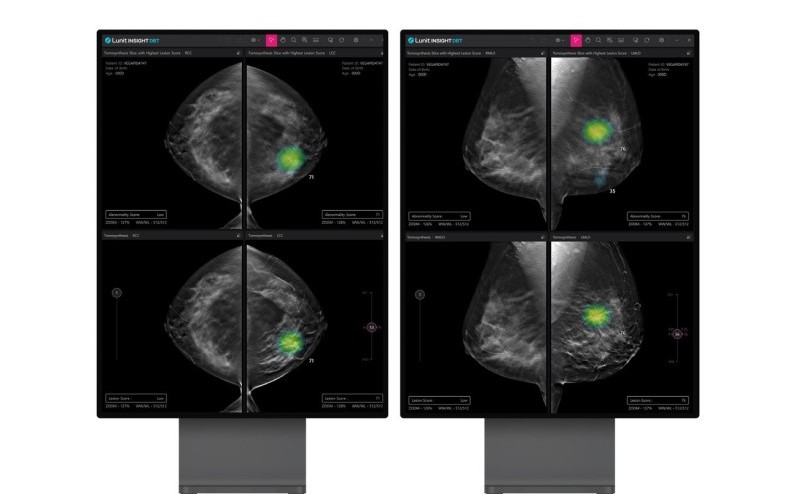 ​루닛의 3차원 유방단층촬영(CT) 및 영상분석 솔루션인 '루닛 인사이트 DBT(디지털유방단층촬영술)'로 촬영한 유방암 영상./루닛 제공​