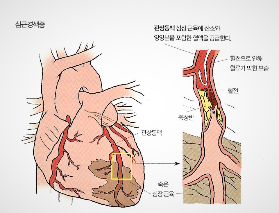 급성 심근경색을 경험한 환자들은 급성 심근경색 병력이 없는 사람보다 혈액암 발생 위험이 높다는 연구가 나왔다. 심장에 혈액을 공급해주는 관상동맥이 막힐 때 발생하는 심근경색증의 발생 메커니즘. / 세브란스병원 '심장병완치설명서'