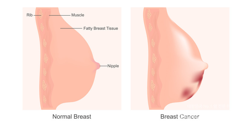 전체 유방암의 15%를 차지하는 삼중음성유방암은 치료가 쉽지 않은 암 중 하나로 꼽힌다. 암세포가 갖고 있어야 할 에스트로겐 수용체(ER), 프로게스테론 수용체(PR), HER2(인간 상피세포 성장인자 수용체2) 단백질 등 3가지 수용체를 갖고 있지 않다는 의미에서 ‘삼중음성’이라는 단어가 붙었다. 사진 오른쪽이 암이 생긴 유방암./게티이미지뱅크