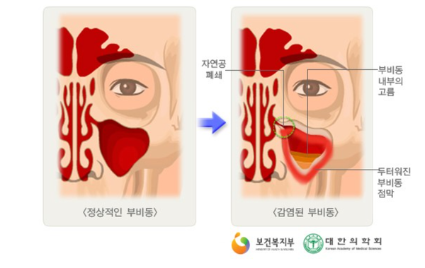 부비동암은 코 속 빈 공간인 비강 주위의 부비동에 생기는 암이다. 통계(2022년 기준)에 따르면 연간 인구 10만명 당 1명이 발생할 정도의 희귀암이다. 머리와 목의 모든 기관(호흡, 소화, 발생, 감각에 관여하는 기관)을 두경부라고 하는데, 부비동은 구강, 인두, 후두, 비인두와 함께 두경부를 구성하는 요소다. 우리가 축농증으로 부르는 증상은 부비동염의 증상 중 하나다./국가건강정보포털 