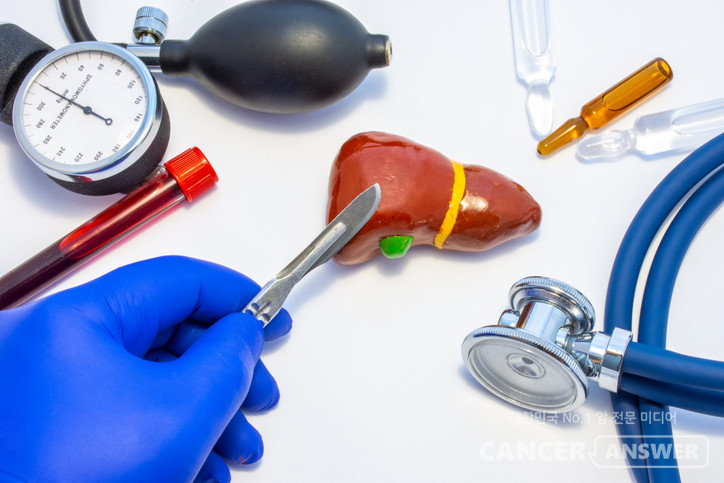 ‘화려한 날들’ 내용처럼 생체 간이식(가족 등 살아있는 공여자)을 하려면 엄격한 조건이 있다. 간을 주는 공여자는 건강해야 하고, 기저 질환이 없어야 하며, 간 크기·혈관 구조·담도 구조가 안전해야 한다./게티이미지뱅크