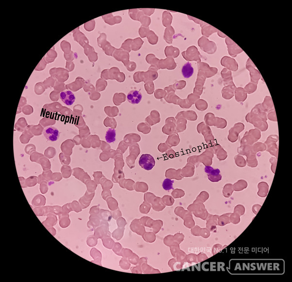 혈액검사를 하면 나오는 여러 항목의 수치 중에 암 치료 중인 환자가 가장 눈여겨봐야 할 항목 중 하나는 호중구다. 우리 혈액 구성 요소 중 하나인 백혈구는 과립구, 림프구, 대식세포로 나뉜다. 모두 면역 기능을 담당한다. 과립구의 95%가 호중구인데, 호중구는 감염 위험을 예측하고, 항암치료 일정에 영향을 미치며, 암 치료 중인 환자의 안전성과 예후를 가늠하는 핵심 요소로 사용된다. 왼쪽 Neutrophil 주변 보라색이 호중구./게티이미지뱅크